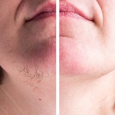 natural body sculpt - permanent hair removal