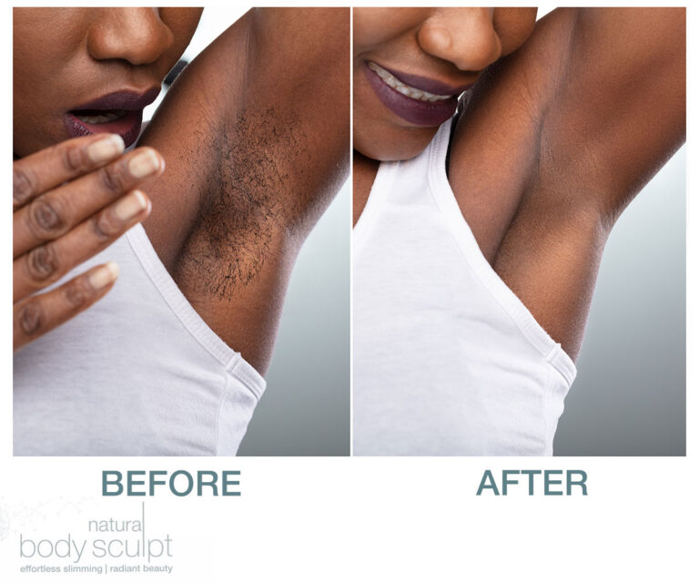 permanent hair removal-underarms-before-after