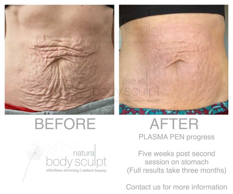 natural body sculpt - plasma pen