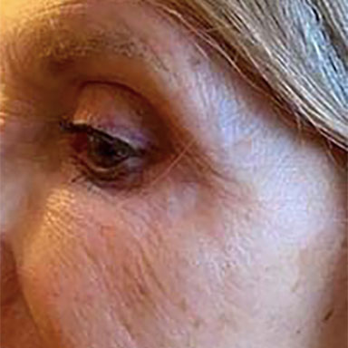natural body sculpt - plasma pen