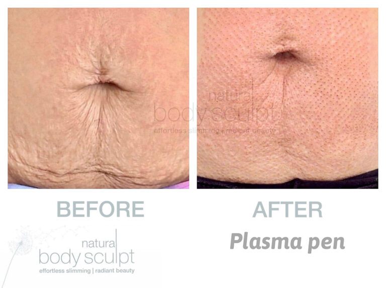 plasma-pen-results-4
