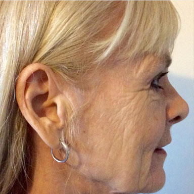 natural body sculpt - radio frequency skin rejuvenation