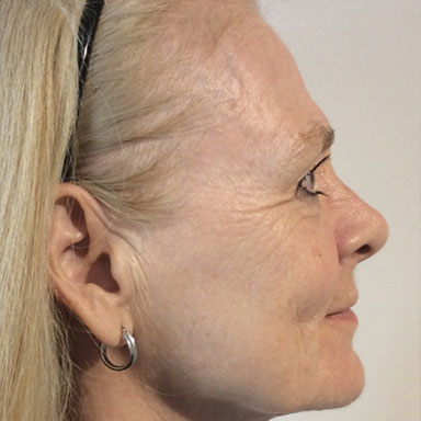 natural body sculpt - radio frequency skin rejuvenation