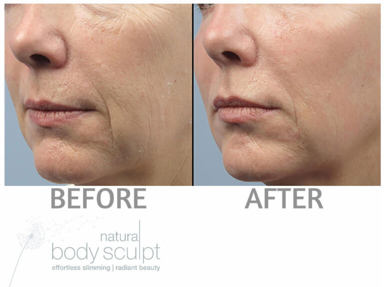rf-micro-needling-1