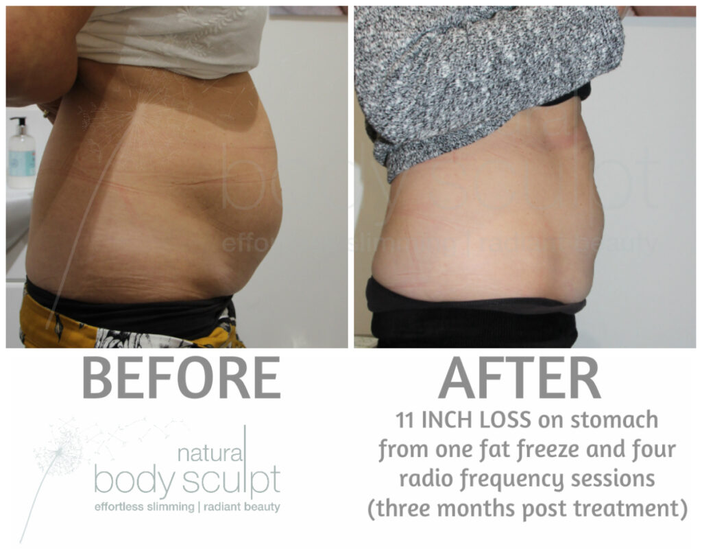 non-surgical lipo suction. our client had a course of fat loss and body sculpt treatments to build muscle, firm skin and reduce fat. fat loss