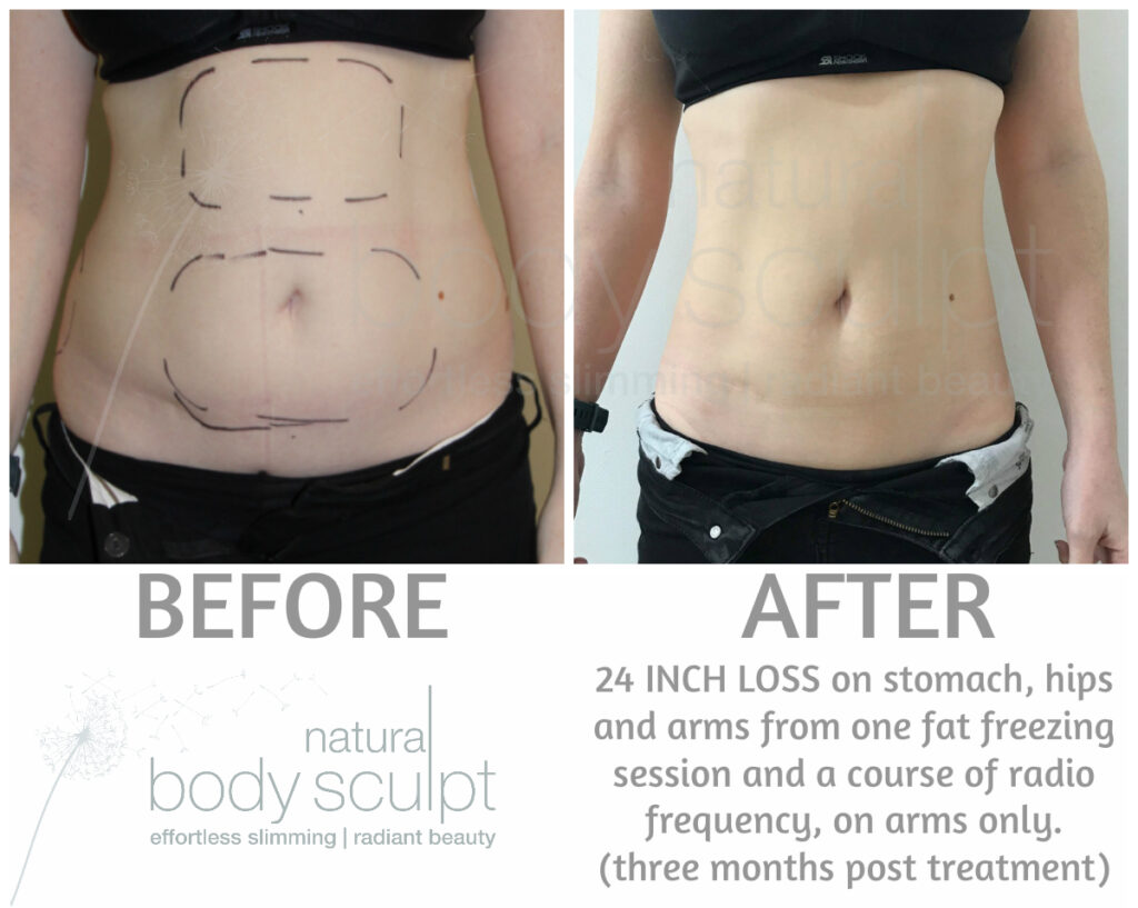 Fat loss and skin tightening results to sculpt the stomach, tightening the skin. 